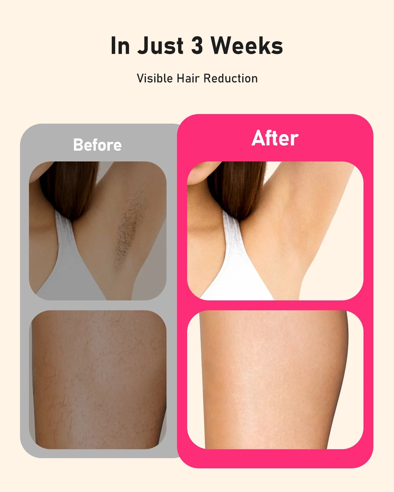 SilkSkin Pro IPL Laser Hair Removal Device